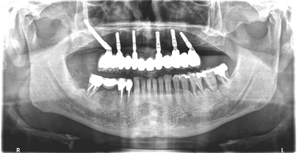 Fig. 3: One zygomatic implant in combination with conventional implants placed where the bone quantity was sufficient.*