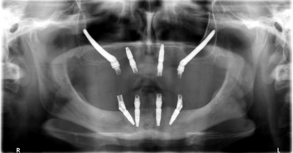 Fig. 4: Two zygomatic implants with two conventional implants.