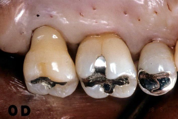 Fig. 2. Clinical appearance immediately prior to surgery. Note severe gingival recession on distal and palatal surfaces.