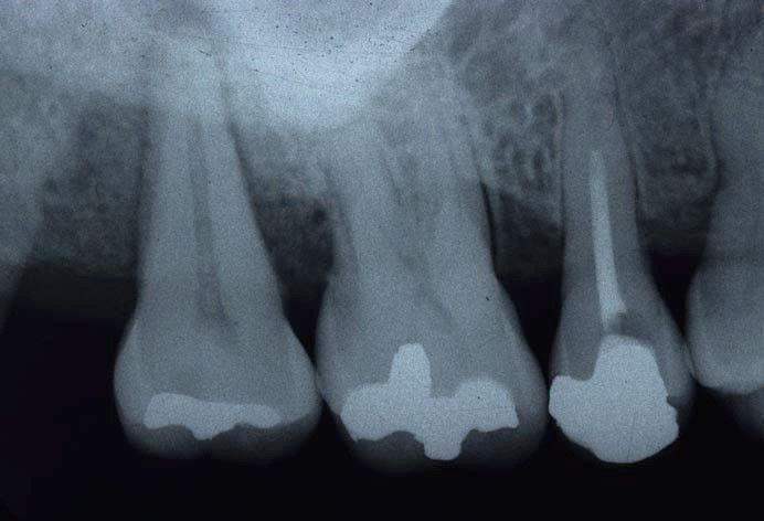 Fig. 1. Baseline radiograph showing a wide and deep defect on distal and palatal surfaces of second molar (distal PD 11 mm, palatal 10 mm and mesial PD 10 mm). Maxillary right second molar has 13mm deep, two-wall intrabony defect involving distal, palatal, and mesial surfaces.