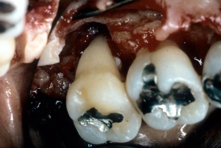 Fig. 3. Clinical appearance of the time of regenerative surgery. Calculus and granulation tissue have removed.  Good visibility and full access to the defect and root surface was assured. Emdogain was applied to the root surface after root conditioning.