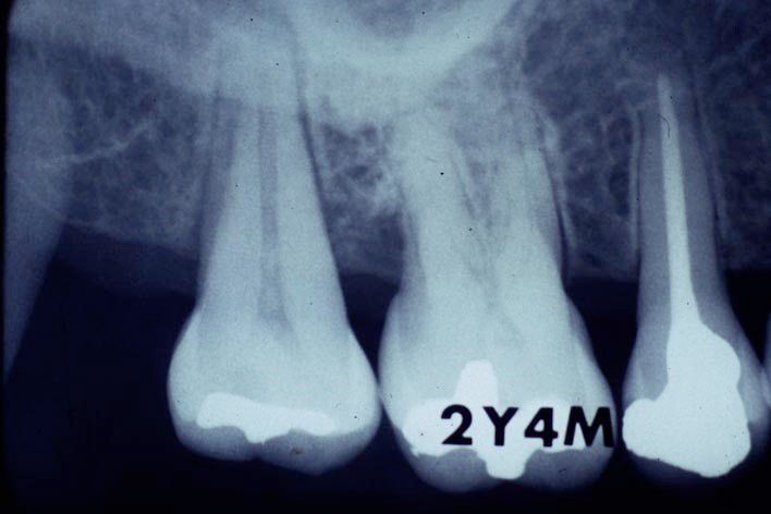 Fig. 4. Radiograph 2 years 4 months post-surgery showing radiographic resolution