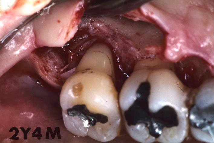 Fig. 5. Reentry after 2 years 4 months surgery demonstrates excellent bone fill on distal and palatal surfaces.