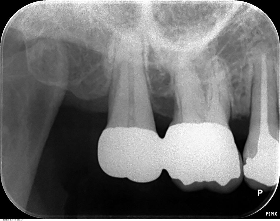 Fig. 6. 12.5 years follow-up RX showing filling of intrabony component defect. And permanent splining was carried out due to resolving her uncomfortable chewing.