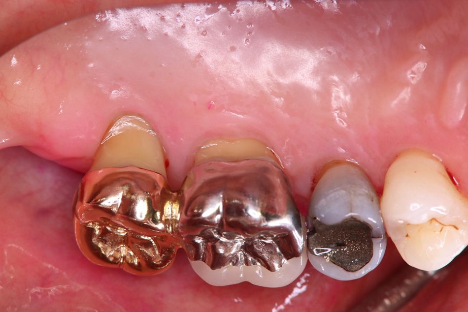 Fig. 7. Clinical appearance of 22.5 years post-surgery showing no inflammation on marginal gingiva.  Note the gingival recession on distal and palatal surfaces due to meticulous brushing.