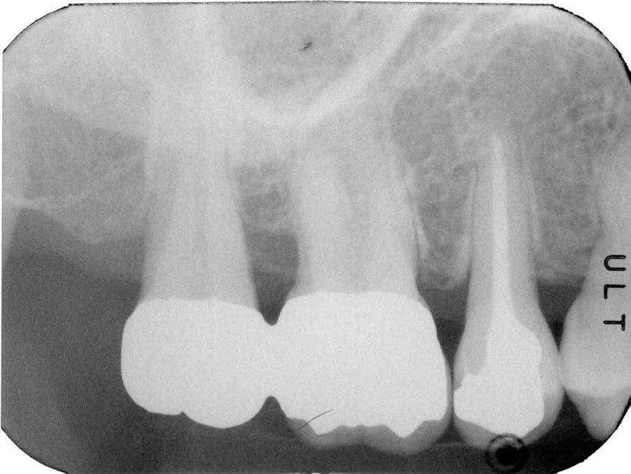 Fig. 8. Radiograph 22.5 years post-surgery showing good bone fill on distal palatal and mesial surfaces. Note the excellent defect fill on distal and mesial of first molar.