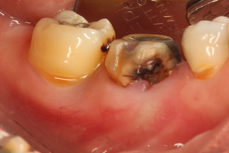 Fig. 1. A systemically healthy 47-year old patient was diagnosed with localized advanced periodontitis on #47 and secondary dental caries on the mesial root of #46. 