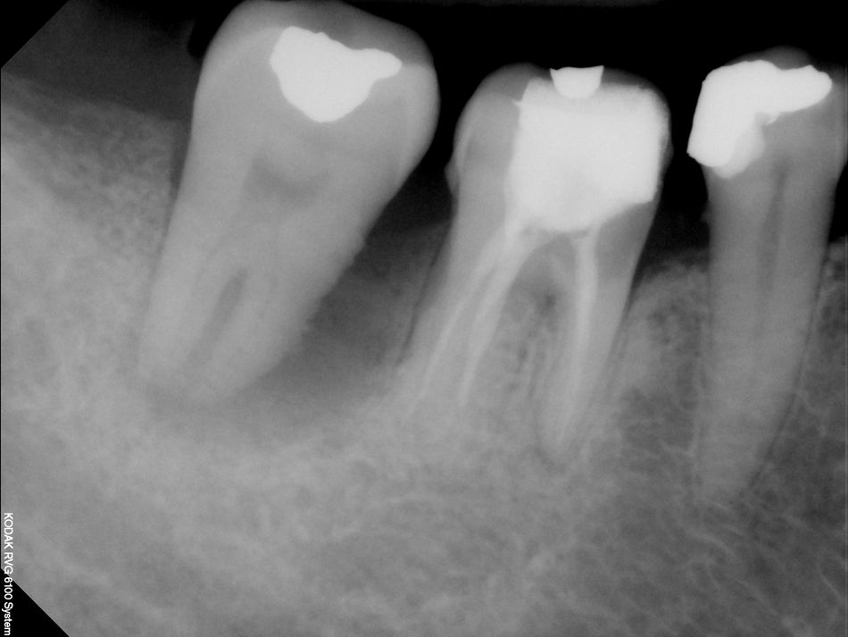 Fig. 2. A pre-operative X-ray revealed a large intra-bony defect in the mesial aspect of the right lower second molar.