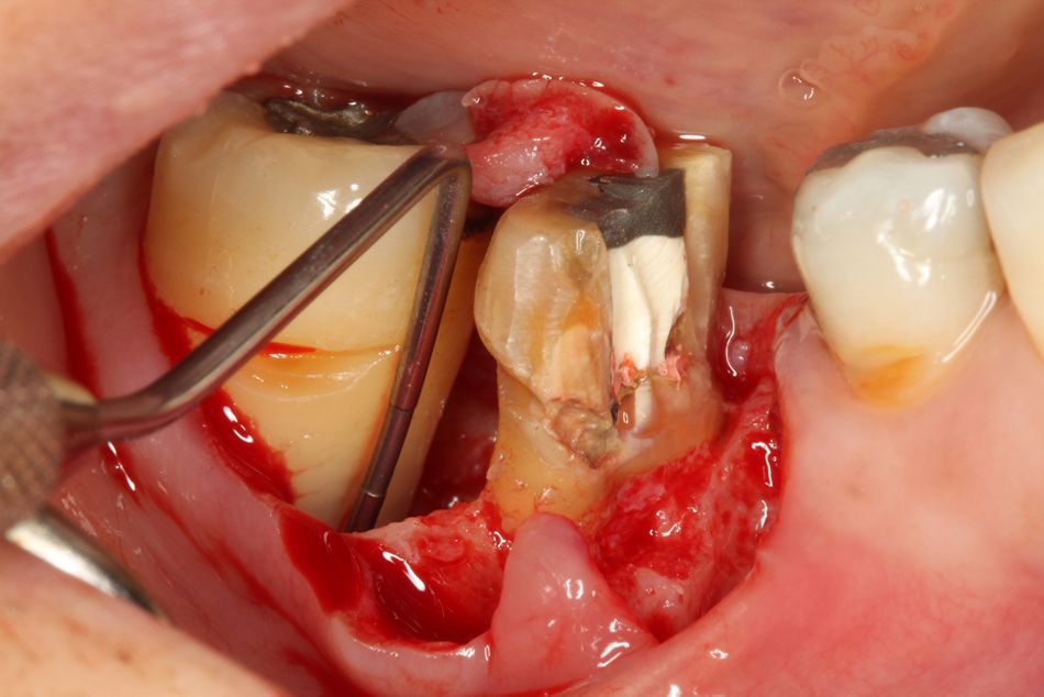 Fig. 4. Tooth #47 had a deep intrabony lesion, which could be classified as a 3-walled defect. For #46, hemisection of the mesial root was performed.