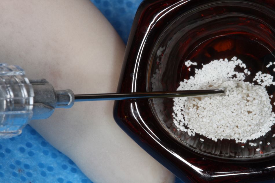 Fig. 5. A synthetic bone substitute was soaked in Emdogain® gel prior to application. Emdogain® coated bone substitute was grafted to the dried defect and root surface.