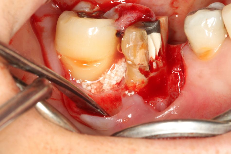 Fig. 6. The remaining Emdogain® gel was applied to the top of the graft. Primary closure was obtained.