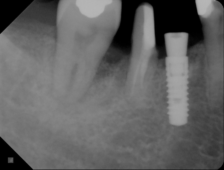 Fig. 8. The radiograph confirmed the clinical observation taken on the day of implant surgery.