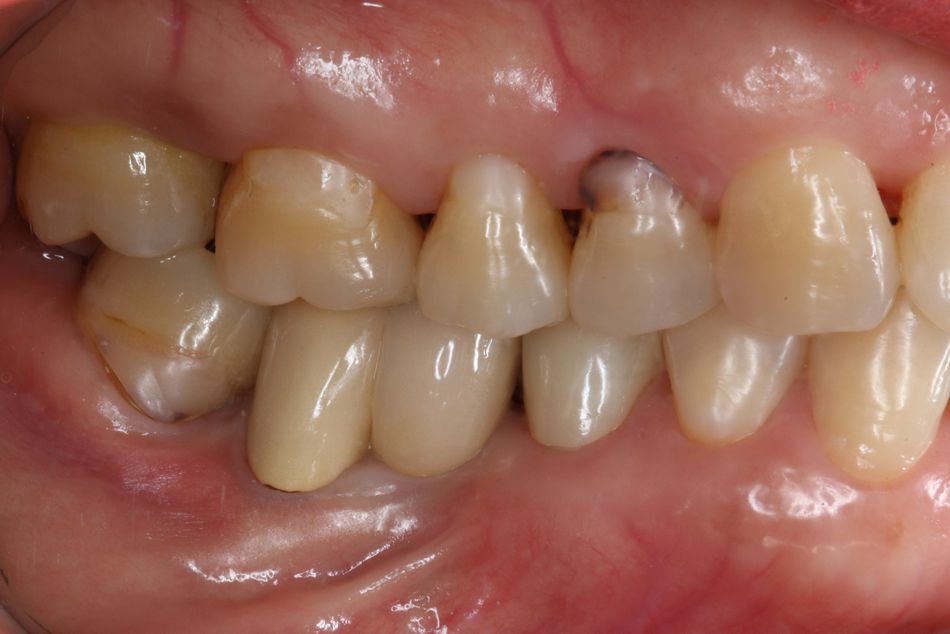 Fig. 9. Clinical photograph and radiograph at 8-year follow-up. Probing depths around the mandibular second molar were within the normal range at less than 3 mm.