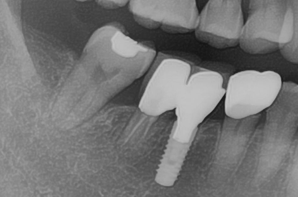 Fig. 10. The radiograph indicated considerable periodontal regeneration with a natural trabecular pattern.