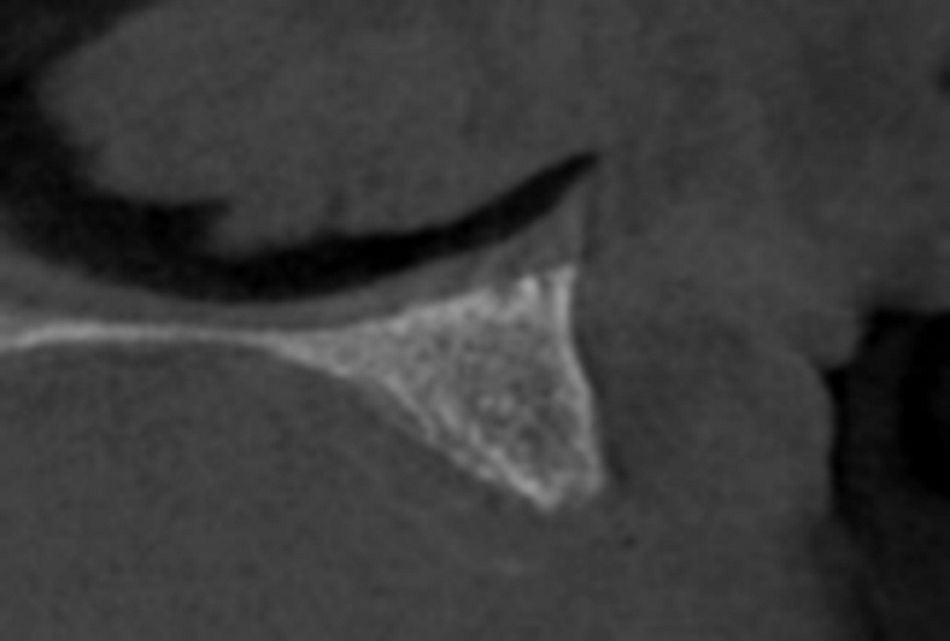 Fig3: remaining bone.