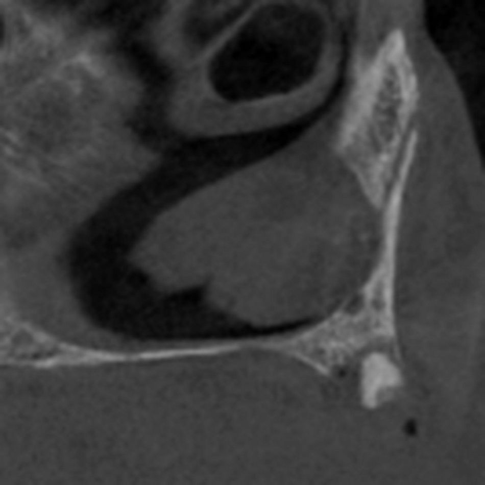 Fig 5: Left side with remaining root