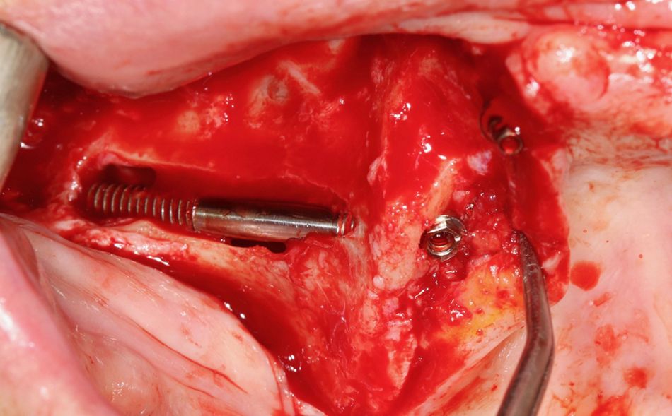 Fig 7: Zygomatic implant on the right side