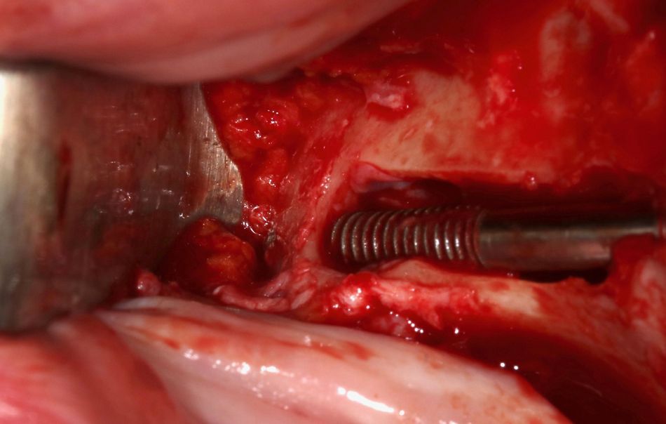Fig 8: Notice the emergence of the zygomatic implant.