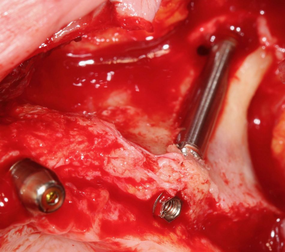 Fig 10: Zygomatic implant on the left side.