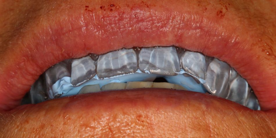 Fig 12: Occlusal registration.