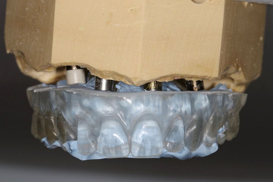 Fig 14: Template filled with bite registration paste used to transfer the model to the simulator.