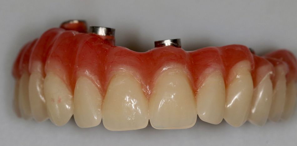 Fig 16: Frontal view