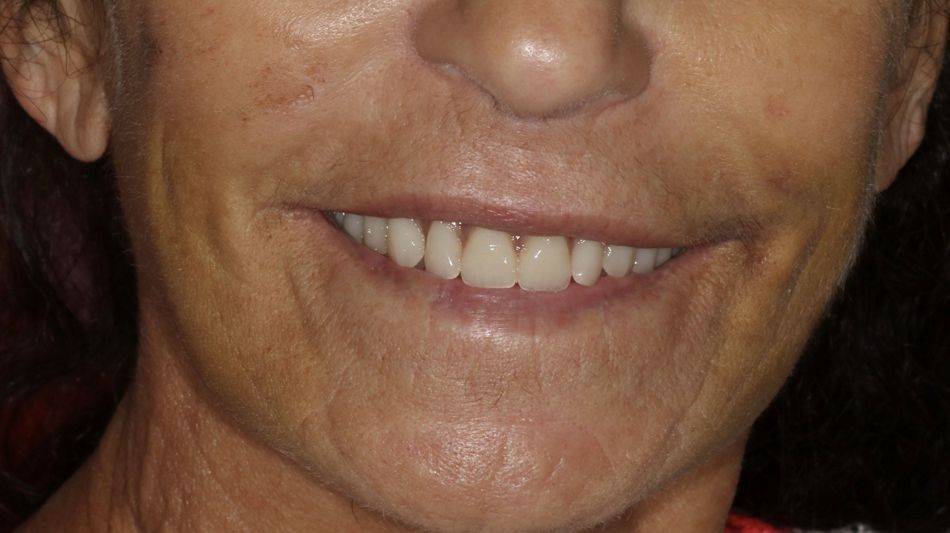 Fig 18: Patient “new smile”