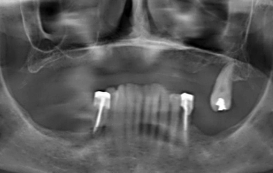 Fig2 : Panoramic X-Ray (after wisdom tooth extraction)