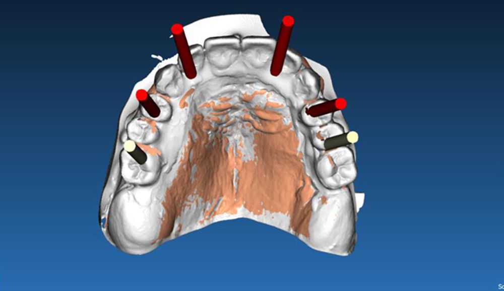 You can now digitally verify full-arch scans with Nexus Connect! The first  A.I enabled implant-scan alignment software. Full-arch scans…