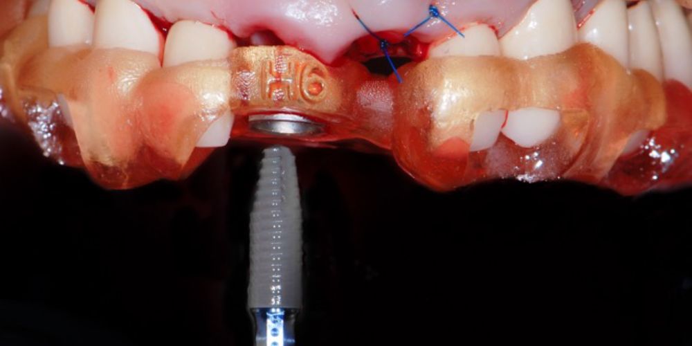 Guided Onestage and Twostage implant placement in the anterior zone