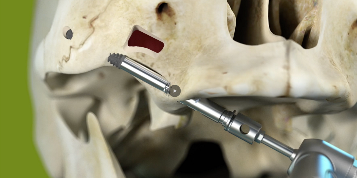 What international experts have to tell you on the Straumann® Zygomatic ...