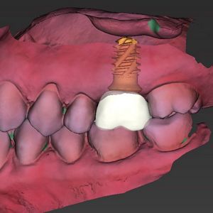 Straumann® TLX Implant System: The Next Level Of Versatility