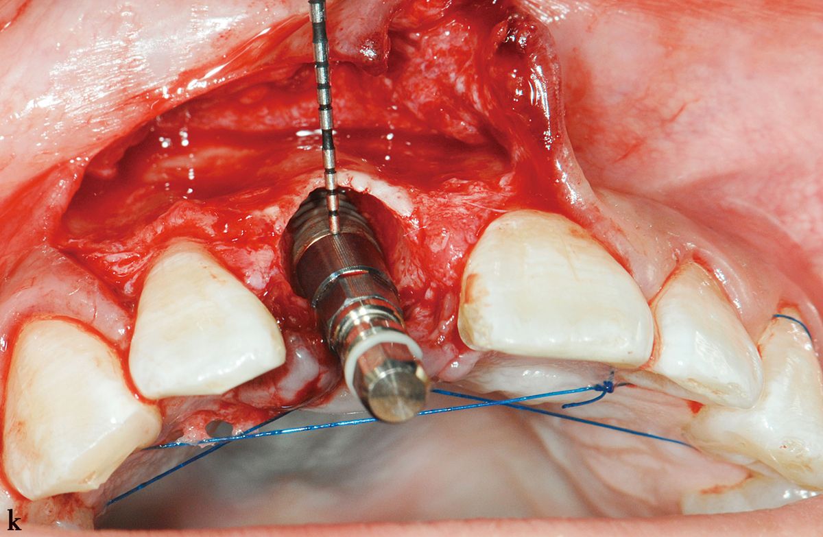 Can You Get a Temporary Tooth During the Dental Implant Process? - Jagare  Dental