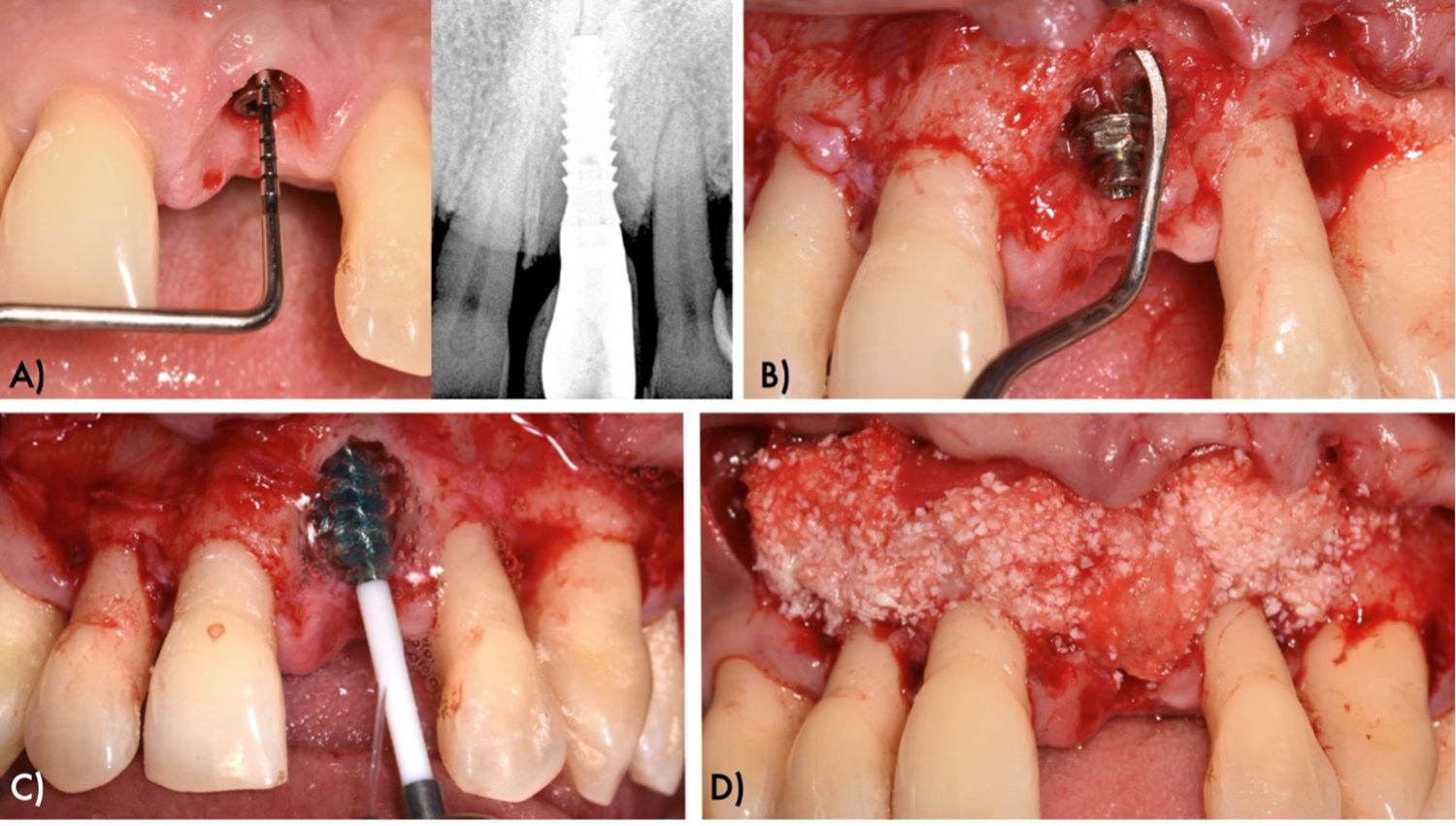 Bone reconstruction: (a) a full-thickness flap was elevated in order to