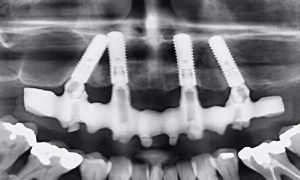 Zygomatic implants: A paradigm shift in the treatment of