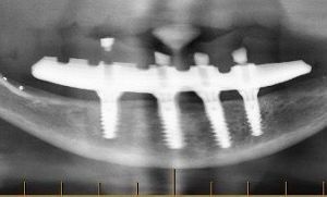 Full-arch rehabilitation with Straumann® TLX implants in a