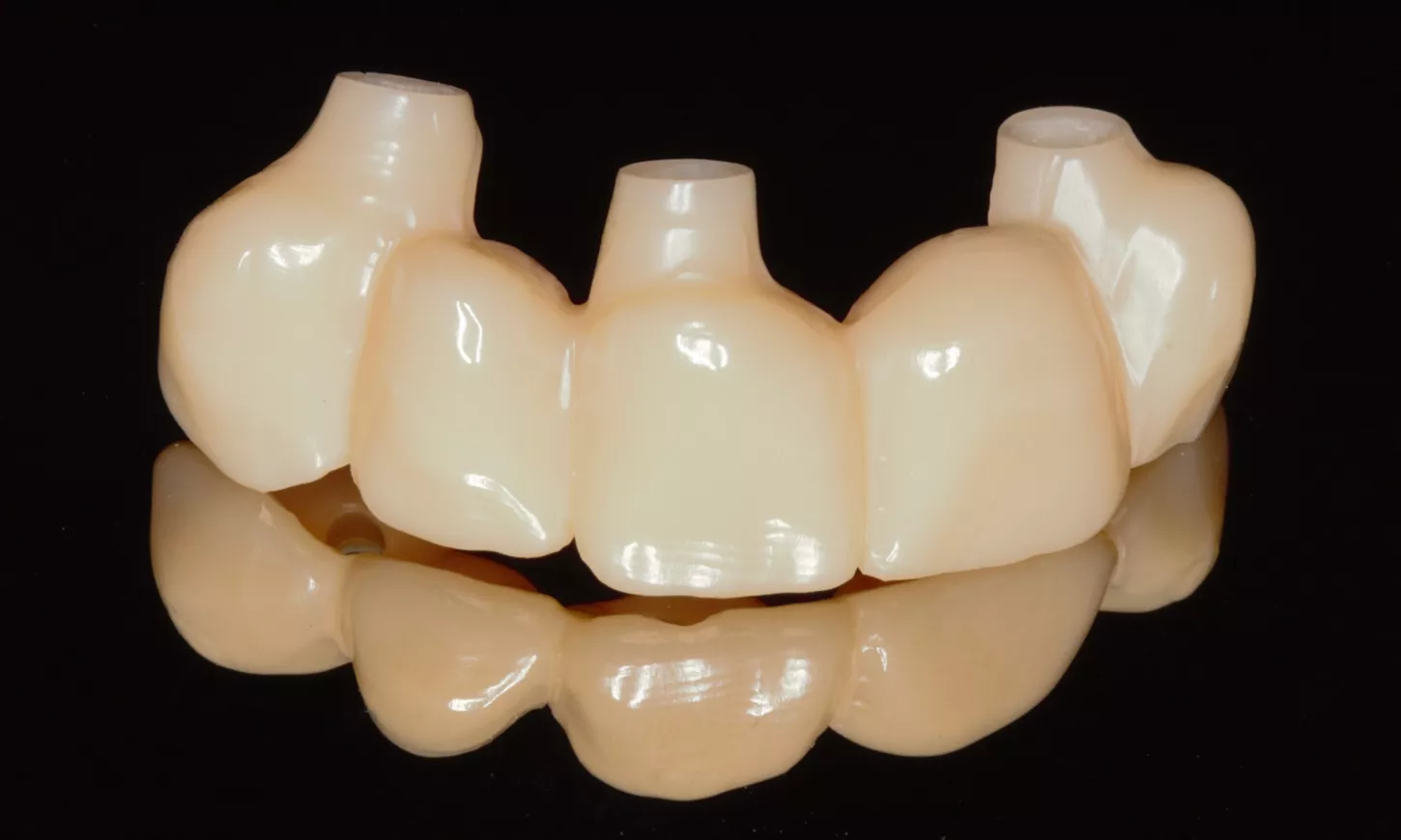 Immediate placement of Straumann® BLX implants, GBR and multiple