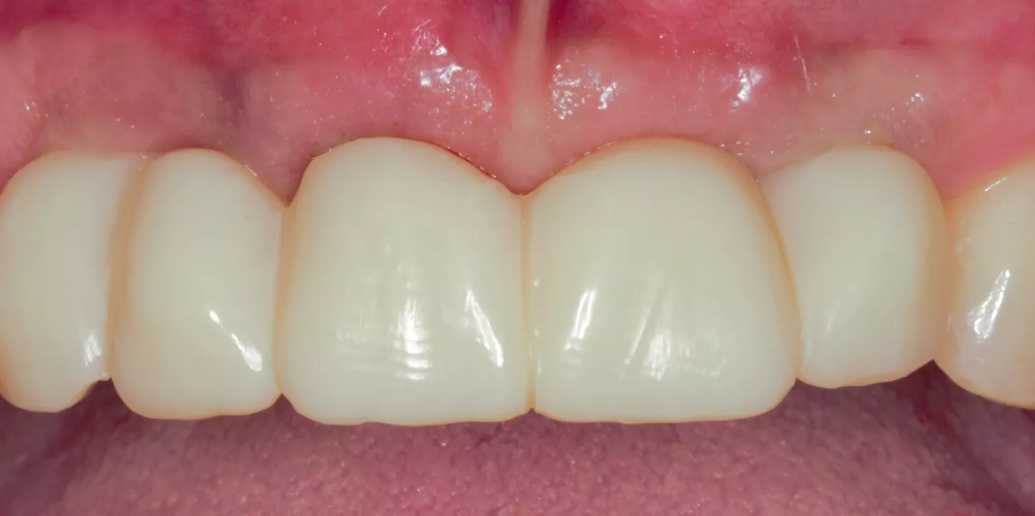 Immediate placement of Straumann® BLX implants, GBR and multiple