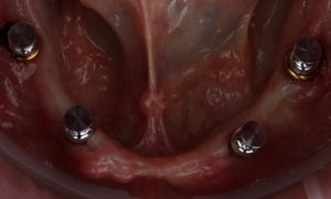 お値下げ相談可能！MAXILLA-ORIENTED IMPLANTOLOGY Maxilla-Oriented Implantology 多数歯欠損・無歯顎症例への