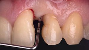 Emdogain® and CTG wall technique: Interdisciplinary approach for