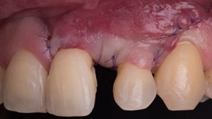 Emdogain® and CTG wall technique: Interdisciplinary approach
