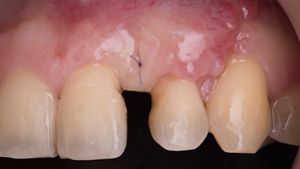 ⚠裁断済み　乳頭再建 = Papilla reconstruction Non-Incised Papilla Surgical Approach and Leukocyte Platelet