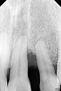 乳頭再建 = Papilla reconstruction Interimplant Papilla Reconstruction in the Esthetic Zone