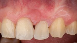 Emdogain® and CTG wall technique: Interdisciplinary approach