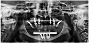 Zygomatic implants: A paradigm shift in the treatment of