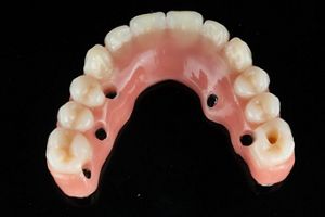 Full-arch rehabilitation using Straumann iEXCEL™ implants