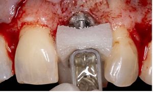 Managing peri-implantitis in the esthetic zone with