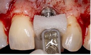 Zero Peri-implantitis Concept インプラント周囲炎 インプラント周囲炎治療について｜インプラント周囲炎治療なら