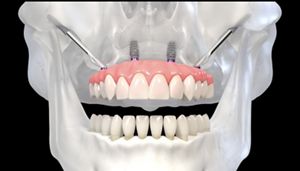Zygomatic implants: A paradigm shift in the treatment of