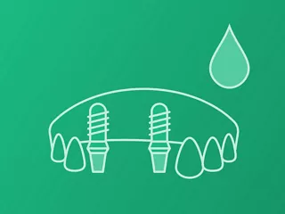 Single-tooth (Screw retained)